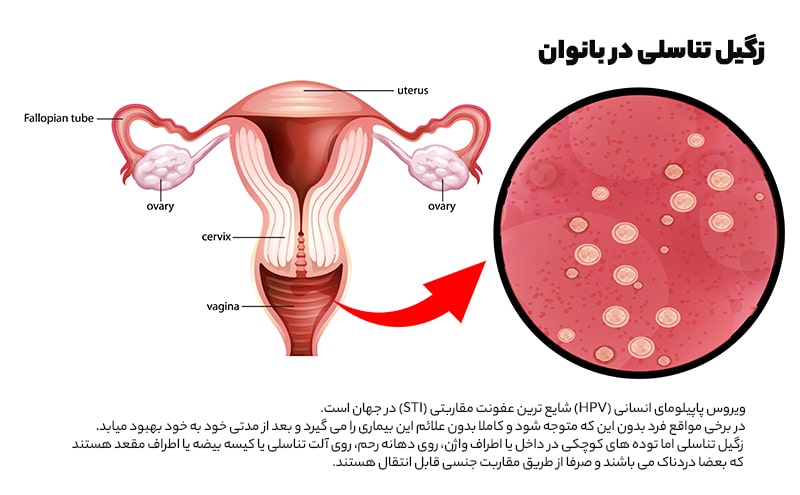 زگیل تناسلی در بانوان