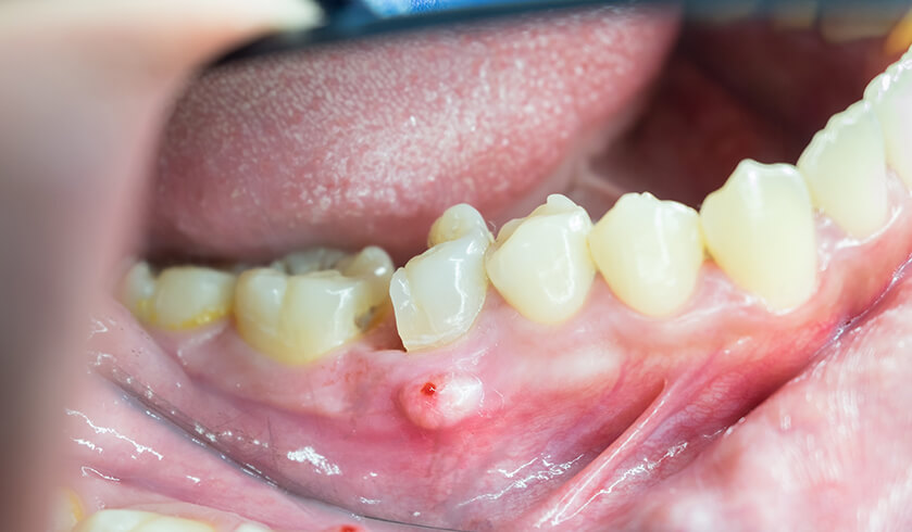 علت ایجاد آبسه دندان